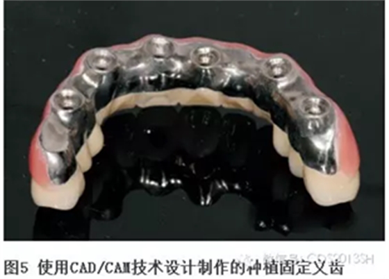 【經(jīng)驗(yàn)分享】無牙頜種植修復(fù)固位的并發(fā)癥與處理&mdash;&mdash;宋應(yīng)亮教授