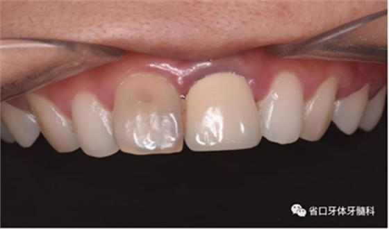 上前牙根管再治療后內(nèi)漂白1例 上前牙根管再治療后內(nèi)漂白1例