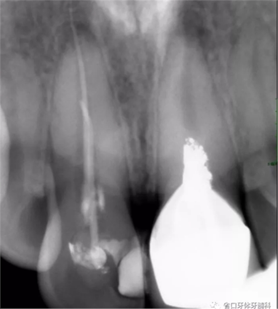 上前牙根管再治療后內(nèi)漂白1例 上前牙根管再治療后內(nèi)漂白1例