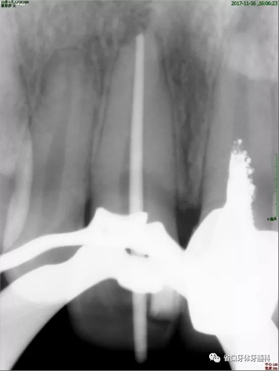 上前牙根管再治療后內(nèi)漂白1例 上前牙根管再治療后內(nèi)漂白1例