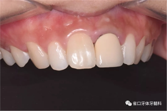 上前牙根管再治療后內(nèi)漂白1例 上前牙根管再治療后內(nèi)漂白1例