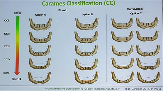【熱點(diǎn)回顧】帶您深度了解無(wú)牙頜種植修復(fù)&mdash;&mdash;Pro Arch