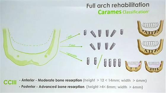 【熱點(diǎn)回顧】帶您深度了解無(wú)牙頜種植修復(fù)&mdash;&mdash;Pro Arch