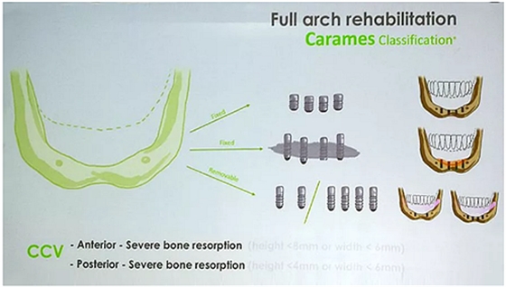 【熱點(diǎn)回顧】帶您深度了解無(wú)牙頜種植修復(fù)&mdash;&mdash;Pro Arch