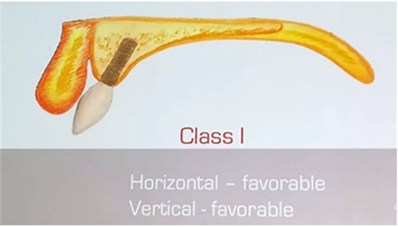 【熱點(diǎn)回顧】帶您深度了解無(wú)牙頜種植修復(fù)&mdash;&mdash;Pro Arch