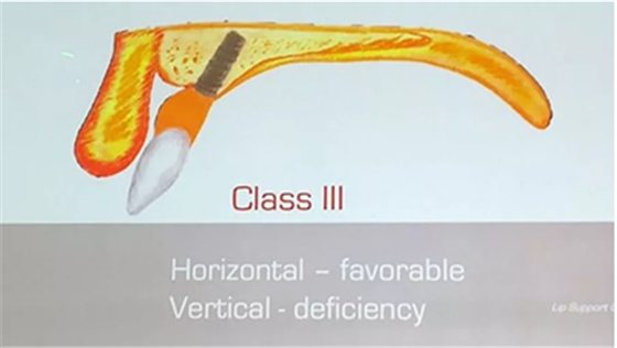 【熱點(diǎn)回顧】帶您深度了解無(wú)牙頜種植修復(fù)&mdash;&mdash;Pro Arch