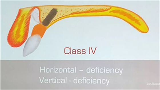 【熱點(diǎn)回顧】帶您深度了解無(wú)牙頜種植修復(fù)&mdash;&mdash;Pro Arch