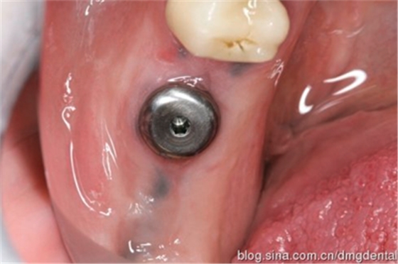 德國(guó)DMG哈尼格二代加聚硅橡膠Heavy種植印模病例展示 Part 1 德國(guó)DMG哈尼格二代加聚硅橡膠Heavy種植印模病例展示 Part 1