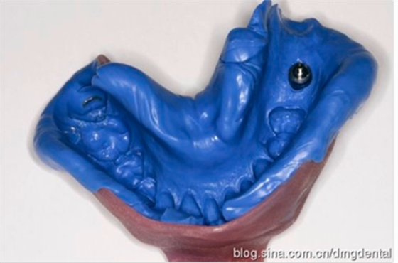 德國(guó)DMG哈尼格二代加聚硅橡膠Heavy種植印模病例展示 Part 1 德國(guó)DMG哈尼格二代加聚硅橡膠Heavy種植印模病例展示 Part 1
