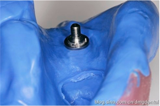 德國(guó)DMG哈尼格二代加聚硅橡膠Heavy種植印模病例展示 Part 1 德國(guó)DMG哈尼格二代加聚硅橡膠Heavy種植印模病例展示 Part 1