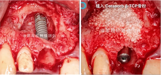 「科普篇」你真的了解它嗎？&mdash;&mdash;β-磷酸三鈣