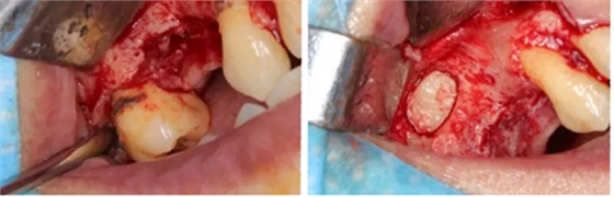 病例賞析 | 上頜竇外提升長期成骨觀察 病例賞析 | 上頜竇外提升長期成骨觀察