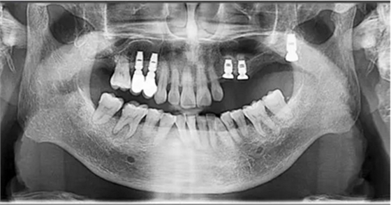 病例賞析 | 上頜竇外提升長期成骨觀察 病例賞析 | 上頜竇外提升長期成骨觀察