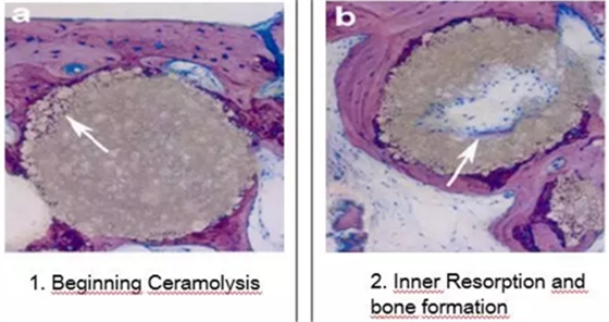 病例賞析 | 上頜竇外提升長期成骨觀察 病例賞析 | 上頜竇外提升長期成骨觀察