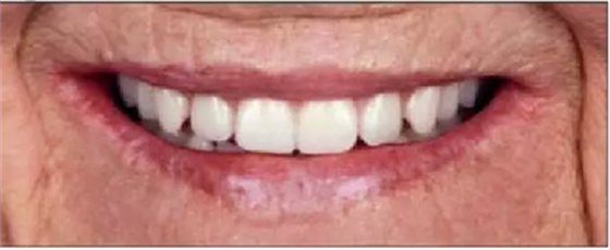 【文獻精讀】唇-齒-牙槽嵴分類：無牙頜上頜牙弓指南。診斷，風險評估及種植治療指征