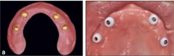 【文獻精讀】唇-齒-牙槽嵴分類：無牙頜上頜牙弓指南。診斷，風險評估及種植治療指征