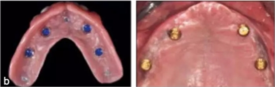 【文獻精讀】唇-齒-牙槽嵴分類：無牙頜上頜牙弓指南。診斷，風險評估及種植治療指征