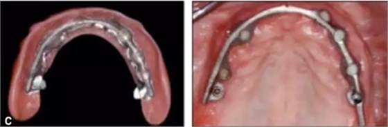 【文獻精讀】唇-齒-牙槽嵴分類：無牙頜上頜牙弓指南。診斷，風險評估及種植治療指征