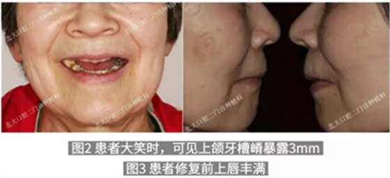 病例報(bào)道│全程數(shù)字化輔助無牙頜種植即刻負(fù)重