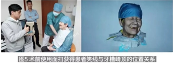 病例報(bào)道│全程數(shù)字化輔助無牙頜種植即刻負(fù)重