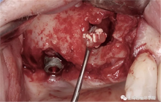 GBR骨生物材料植骨失敗后，利用BBA植骨法及軟組織處理病例