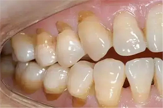 今天開始不要再這樣刷牙了，你的牙齒快被刷掉了！