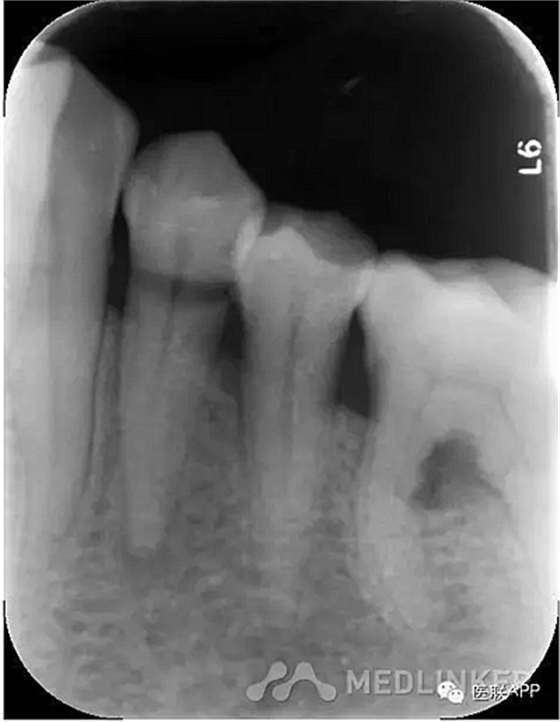 楔狀缺損導(dǎo)致根尖周炎 楔狀缺損導(dǎo)致根尖周炎