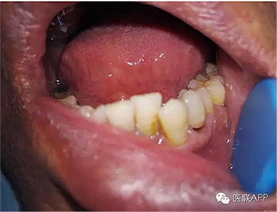 楔狀缺損導(dǎo)致根尖周炎 楔狀缺損導(dǎo)致根尖周炎