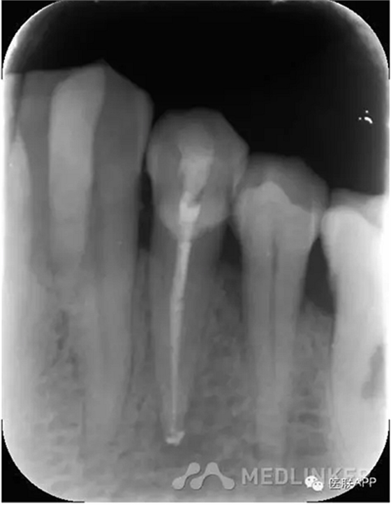 楔狀缺損導(dǎo)致根尖周炎 楔狀缺損導(dǎo)致根尖周炎
