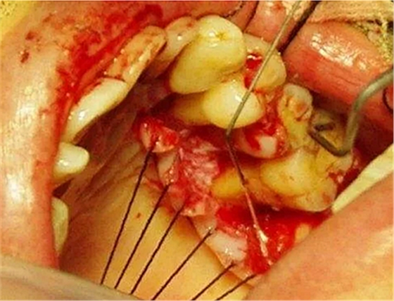 上海嘉?？谇谎芯克皇兰o牙周病的臨床進展