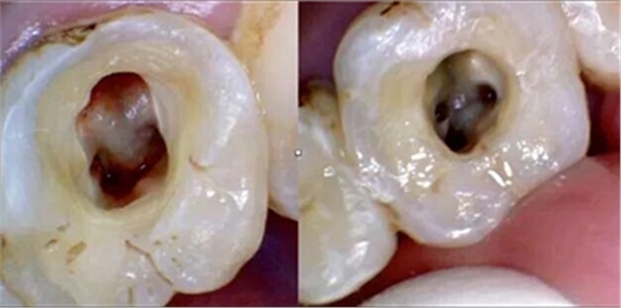 上海嘉?？谇谎芯克皇兰o(jì)根管治療的進(jìn)展