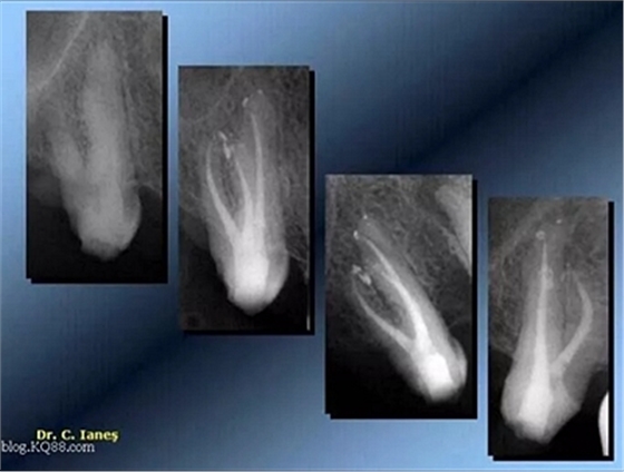 上海嘉?？谇谎芯克皇兰o(jì)根管治療的進(jìn)展