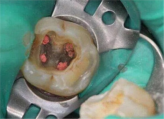 .上海嘉?？谇谎芯克皇兰o(jì)根管治療的進(jìn)展