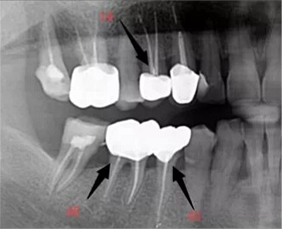 上海嘉?？谇谎芯克皇兰o(jì)根管治療的進(jìn)展
