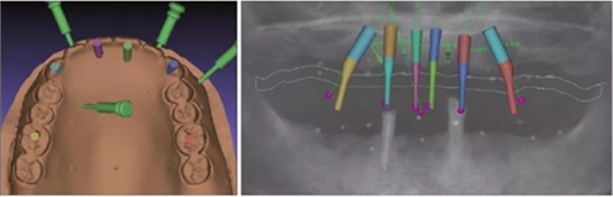 【專家共識(shí)】種植修復(fù)臨床評(píng)價(jià)標(biāo)準(zhǔn)