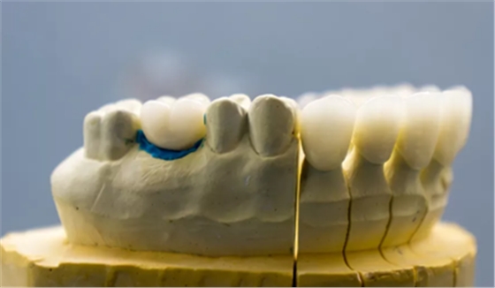 半路殺出粘接性修復(fù)體，真有那么神奇？