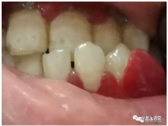 牙周炎，中國成年人后半生永遠的 痛 ！