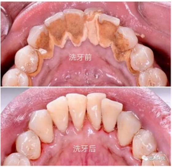 牙周炎，中國成年人后半生永遠的 痛 ！