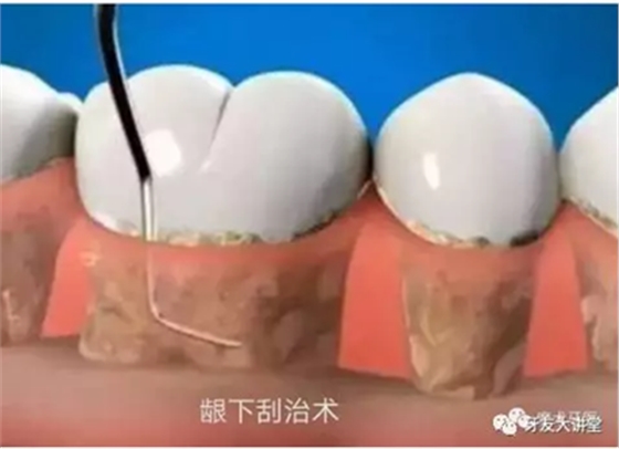 牙周炎，中國成年人后半生永遠的 痛 ！