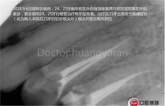 當(dāng)根管治療遇見(jiàn)根尖骨穿孔