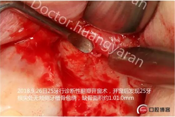 當(dāng)根管治療遇見(jiàn)根尖骨穿孔