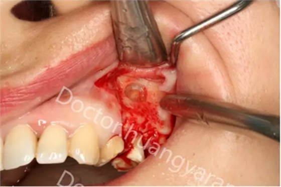 當(dāng)根管治療遇見(jiàn)根尖骨穿孔