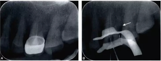 （六期）細小鈣化根管的疏通&mdash;&mdash;病因及診斷