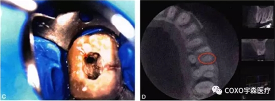 （六期）細小鈣化根管的疏通&mdash;&mdash;病因及診斷