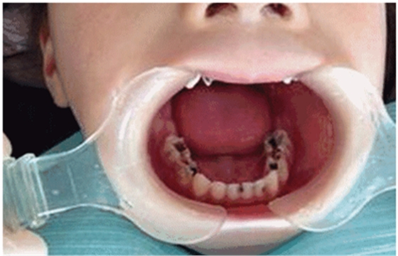 兒童齲病的預(yù)防 兒童齲病的預(yù)防