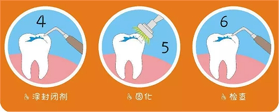 兒童齲病的預(yù)防 兒童齲病的預(yù)防