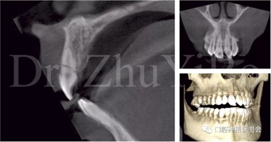 牙科種植 牙科種植