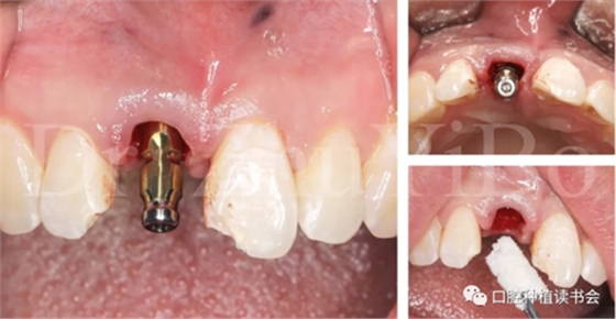 牙科種植 牙科種植