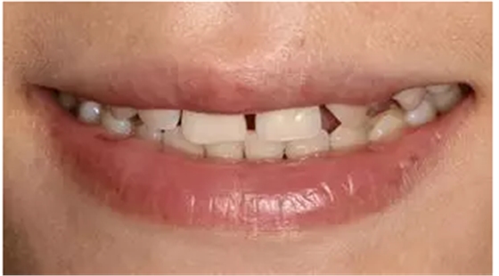 病例分享|復(fù)合樹脂微創(chuàng)美學(xué)修復(fù)關(guān)閉上前牙間隙 病例分享|復(fù)合樹脂微創(chuàng)美學(xué)修復(fù)關(guān)閉上前牙間隙