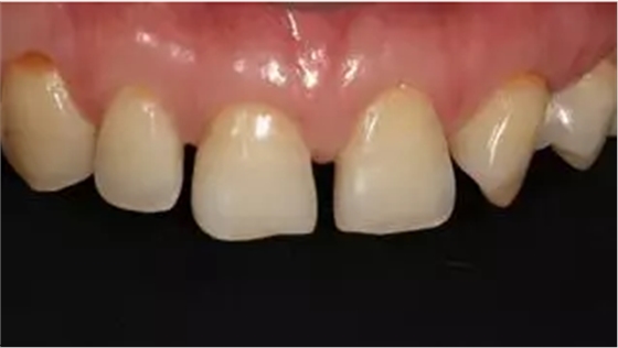 病例分享|復(fù)合樹脂微創(chuàng)美學(xué)修復(fù)關(guān)閉上前牙間隙 病例分享|復(fù)合樹脂微創(chuàng)美學(xué)修復(fù)關(guān)閉上前牙間隙